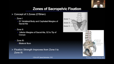 An image from the "Sacropelvic Fixation & Iliac Crest Graft Surgical Demonstration: Surgical Demonstration with Rajesh Arakal, MD" video on the JnJInstitute.com website.