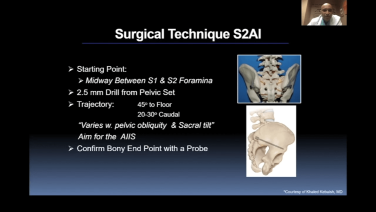 Thumbnail image of Sacropelvic Fixation & Iliac Crest Graft Surgical Techniques: S2AI with Rajesh Arakal, MD