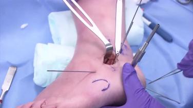 An image from the "Anterolateral Calcaneal Plates Surgical Demonstration with Michael Swords, DO" video on the JnJInstitute.com website.