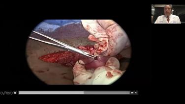 An Image From "Wound Closure: Gynecologic Surgery in the New Normal – Making Device Choices to Keep it Simple and Efficient with Steven D. McCarus, MD, FACOG and Lori L. Warren, MD, FACOG, FPMRS"