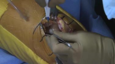 image of "Making the Incision with Robert Gorab, MD" video on jnjinstitute.com