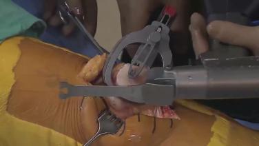 An image from the "Patella Resection with Robert Gorab, MD" video on the JnJInstitute.com website.