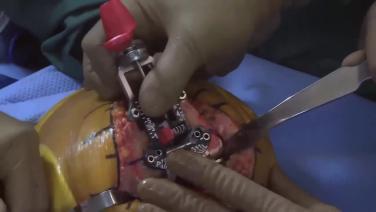 An image from the "Measured Resection with Robert Gorab, MD" video on the JnJInstitute.com website.