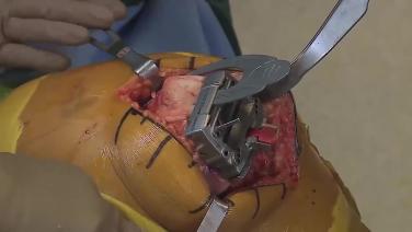 An image from the "Tibia Preparation with Robert Gorab, MD" video on the JnJInstitute.com website.
