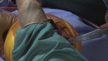 An image from the "Femoral Box Resection with Robert Gorab, MD" video on the JnJInstitute.com website.