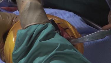 image of "Femoral Box Resection with Robert Gorab, MD" video on jnjinstitute.com