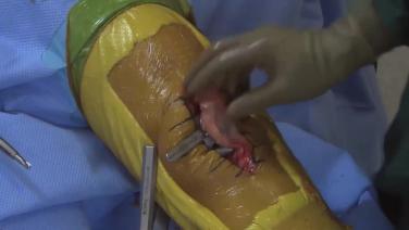 image of "Implant Trialing with Robert Gorab, MD " video on jnjinstitute.com