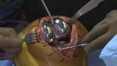 An image from the "ATTUNE® Knee System: Implant Placement with Robert Gorab, MD" video on the JnJInstitute.com website.
