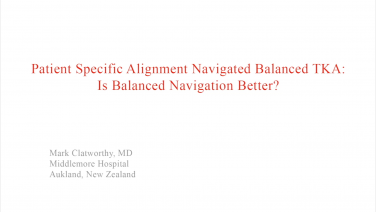 An image from the "Patient Specific Alignment: Tibia First Navigated Balance TKA Approach - Benefits of Balanced Approach" video on the JnJInstitute.com website.