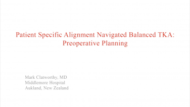 An image from the "Patient Specific Alignment: Tibia First Navigated Balance TKA Approach - Interoperative Planning" video on the JnJInstituet.com website.