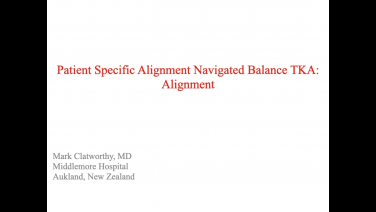 An image from the "Patient Specific Alignment: Tibia First Navigated Balance TKA Approach - Alignment' video on the JnJInstitute.com website.