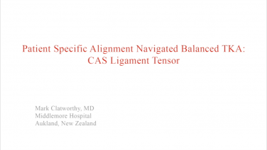 An image from the "Patient Specific Alignment: Tibia First Navigated Balanced TKA Approach - CAS Ligament Tensor" video on the JnjInstitute.com website.