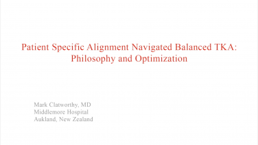 An image from the "Patient Specific Alignment: Tibia First Navigated Balanced TKA Approach - TKA Balance Philosophy & Optimization" video on the JnJInstitute.com website.
