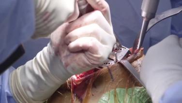 An image from the "ATTUNE® Cementless: Femoral Cut with David Dalury, MD & Ryan Nunley, MD" video on the JnJInstitute.com website.