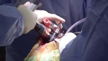 An image from the "ATTUNE® Cementless: Femoral Preparation with David Dalury, MD & Ryan Nunley, MD" video on the JnJInstitute.com website.