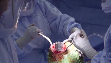 An image from the "ATTUNE® Cementless: Tibia Preparation with David Dalury, MD & Ryan Nunley, MD" video on the JnJInstitute.com website.
