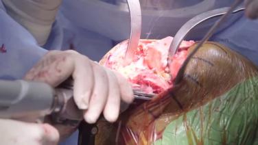 An image from the "ATTUNE® Cementless: Tibial Resection and Alignment with David Dalury, MD & Ryan Nunley, MD" video on the JnJInstittue.com website.
