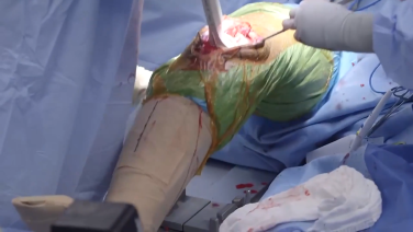 An image from the "ATTUNE® Cementless: Recutting the Tibia with David Dalury, MD & Ryan Nunley, MD" video on the JnJInstitute.com website.