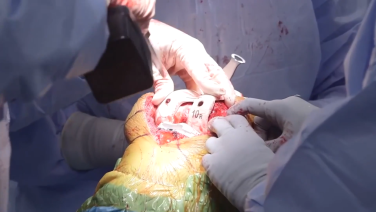 An image from the "ATTUNE® Cementless: Trialing & Checking the PCL with David Dalury, MD & Ryan Nunley, MD" video on the JnJInstitute.com website.