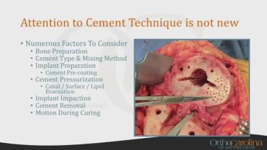 Current Techniques & Fixation in Total Knee Arthroplasty: Cementing Techniques with Keith Fehring, MD thumbnail image