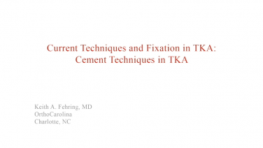 An image from the "Current Techniques & Fixation in Total Knee Arthroplasty: Background & Experience" video on the JnJInstitute.com website.