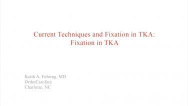 An image from the "Current Techniques & Fixation in Total Knee Arthroplasty: Evolution of Bone Cementing Techniques" video on the JnJInstitute.com website.