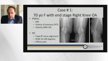 An image from the "Current Techniques & Fixation in Total Knee Arthroplasty: Case Examples" video on the JnJInstitute.com website.