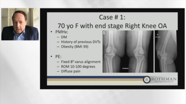 An image from the "Current Techniques & Fixation in Total Knee Arthroplasty: Case Examples" video on the JnJInstitute.com website.