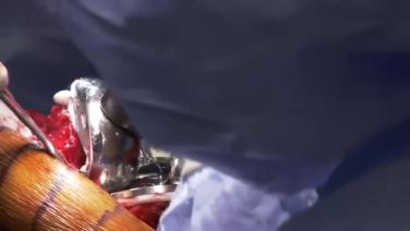 image of Surgical Techniques featuring ATTUNE® Revision Knee System & the KINCISE™ Automated Impactor: Femoral Component Implantation with Ryan Nunley, MD video on jnjinstitute.com