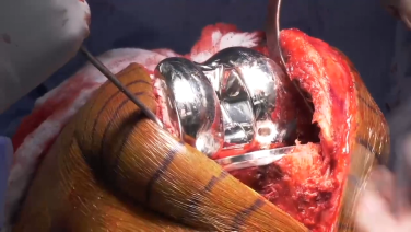 An image from the "ATTUNE Revision: Polyethylene Insert Trial with Ryan Nunley, MD" video on the JnJInstitute.com website.