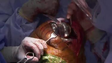 image of Surgical Techniques featuring ATTUNE® Revision Knee System & the KINCISE™ Automated Impactor: Polyethylene Insert Trial with Ryan Nunley, MD video on jnjinstitute.com