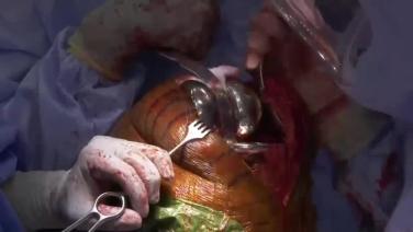 image of Surgical Techniques featuring ATTUNE® Revision Knee System & the KINCISE™ Automated Impactor: Polyethylene Insert Trial with Ryan Nunley, MD video on jnjnstitute.com