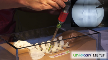 An image from the "UNLEASH™ MIS TLIF Procedural Solution with Michael Wang, MD" video on the JnJInstitute.com website.