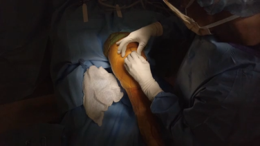 PDF] Dermabond wound closure in primary hip arthroplasty.