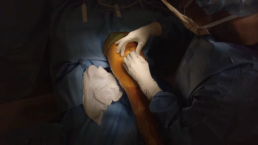 An Image From "Total Knee Arthroplasty Using DERMABOND™ PRINEO™ and STRATAFIX™"