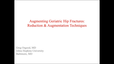 An image from the "Augmenting Geriatric Hip Fractures: Reduction & Augmentation Techniques with Greg Osgood, MD" video on the JnJInstitute.com website.