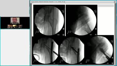 image of Augmenting Geriatric Hip Fractures: Logical Indications Through Case Examples with Michael Gardner, MD video on jnjinstitute.com