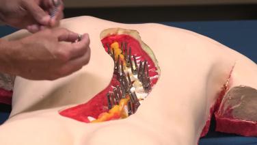 Pedicle Cannnulation in the Thoracic Spine: Freehand Technique with Suken Shah, MD thumbnail