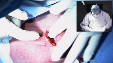 An image from the "UNLEASH™ Lateral Procedural Solution with Andrew Sama, MD" video on the JnJInstitute.com website.