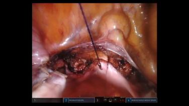 An Image from "Bladder Flap Dissection, Colpotomy, and Vaginal Cuff Closure During Robotic Hysterectomy Procedure Featuring STRATAFIX™ Symmetric Knotless Tissue Control Devices with Marc Winter, MD"