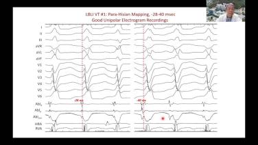 ECG Diagnosis and Catheter Ablation in Patients with Genetic Arrhythmia Syndromes with Henry Hsia, MD Header Image