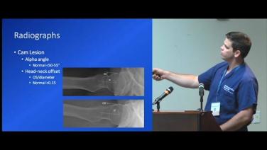 Femoracetabular Impingement with Jonathan Salava, MD thumbnail