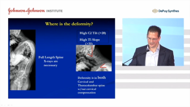 image of Cervical Alignment & Classification: Classification System with Christopher Ames, MD video on jnjinstitute.com