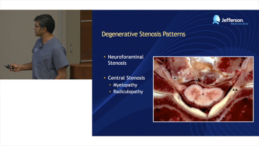 image of Cervical Spine Anatomy for Decompression: Degenerative Stenosis Foraminal Decompression with Srinivas Prasad, MD video on jnjinstitute.com