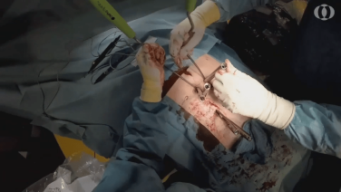 An image from the "Navigated Workflow: Rod Placement & Removing the Extensions" video on the JnJInstitute.com website.