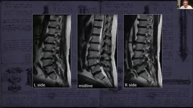 An image from the "The 123s of Minimally Invasive Approaches through Case Presentations with Roger Hartl, MDThe 123s of Minimally Invasive Approaches through Case Presentations with Roger Hartl, MD" video on the JnJInstitute.com website.