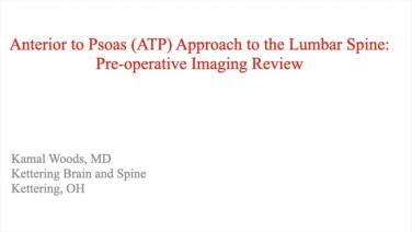 image from "Anterior to Psoas (ATP) Approach to the Lumbar Spine: Preoperative Image Review" video on jnjinstitute.com