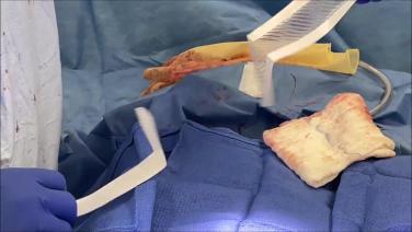 An Image From "Pfannenstiel Incision Closure Featuring MONOCRYL® Plus Antibacterial (poliglecaprone 25) Suture and DERMABOND® PRINEO® Skin Closure System with Jonathan D. Black, MD, MPH"