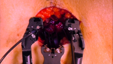 image of "Single Position Anterior to Psoas Surgical Approach with Chi Lim, MD" video on jnjinstitute.com
