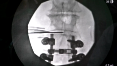 An image from the "Minimally Invasive Direct Lateral Approach with Puya Alikhani, MD" video on the JnJInstitute.com website.